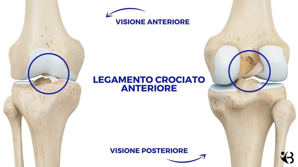Crociato anteriore rotto: sintomi, cosa fare, esercizi e tempi di ...